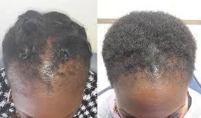 Raw Batana Oil for Hair Growth - 100% Pure, Organic 4oz Batana from Honduras for Thick and Strong Natural Hair - Dr. Sebi Unrefined Cold Pressed Cosmetic Scalp Mask for Men & Women (1 Pack)