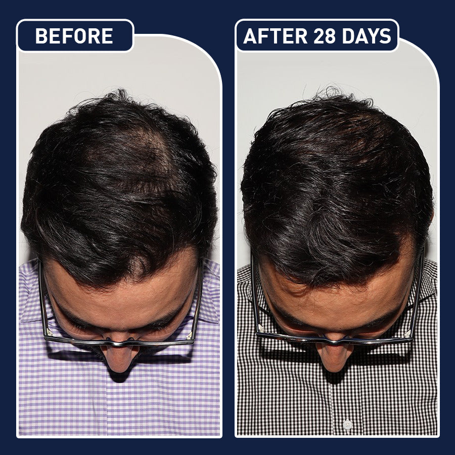 FEG Plus Hair Growth Spray 45% Off Limited Offer